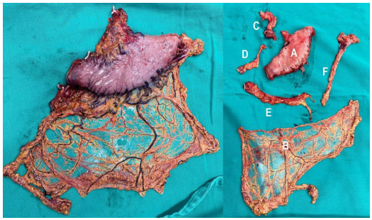 Izquierda, esp&eacute;cimen quir&uacute;rgico del grupo A, sin modificaci&oacute;n despu&eacute;s de su extracci&oacute;n. Derecha, esp&eacute;cimen del grupo B, en el que se realiz&oacute; una divisi&oacute;n por grupos ganglionares.