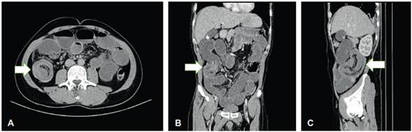 Tomografía computarizada de abdomen con contraste neutro. A. Corte axial donde se aprecia el “signo de la diana” por invaginación intestinal de asas ileales distales en flanco derecho (flecha). B. Reconstrucción coronal, que muestra el asa intususcepta en flanco derecho (flecha), que condiciona sobredistensión de las asas intestinales proximales por obstrucción mecánica asociada. C. Reconstrucción sagital donde se observa el “signo de la salchicha” causado por la masa con capas alternas de baja y alta densidad, que impresiona telescopaje intestinal (flecha).