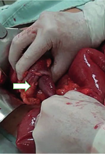 Imagen intraoperatoria de la invaginación de 50 cm de intestino delgado al interior del ciego (flecha).