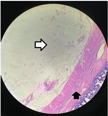 Imágenes microscópicas. Ampliación microscópica con objetivo 40x. Los cortes muestran pared de intestino delgado con tumor benigno delimitado, constituido por lóbulos de tejido adiposo maduro, compatible con lipoma submucoso (Flecha blanca). La mucosa suprayacente está aplanada. Otras áreas muestran congestión vascular. No hay malignidad en la muestra examinada. Nótese en la imagen capa muscular interna (Flecha negra).