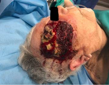 Morfolog&iacute;a macrosc&oacute;pica del tumor primario. Lesi&oacute;n exof&iacute;tica, ulcerada, de gran tama&ntilde;o, localizado en la sien derecha.