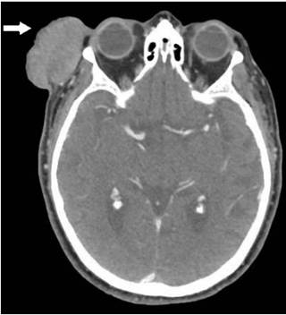 Corte axial de la tomograf&iacute;a computarizada. Se observa la lesi&oacute;n tumoral primaria exof&iacute;tica y de gran tama&ntilde;o, localizada en sien derecha (flecha blanca).