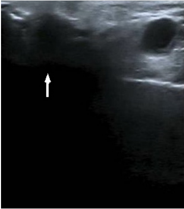 Ecograf&iacute;a de gl&aacute;ndula par&oacute;tida derecha, donde se puede apreciar un n&oacute;dulo hipog&eacute;nico (flecha blanca), compatible con met&aacute;stasis tumoral.