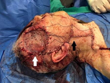 Resultado quir&uacute;rgico de la ex&eacute;resis tumoral, logrando la cobertura del defecto con injerto de piel parcial (flecha blanca). Se observan las incisiones para la parotidectom&iacute;a (incisi&oacute;n de Blair modificada) y linfadenectom&iacute;a cervical (incisi&oacute;n de Martin) (flecha negra).