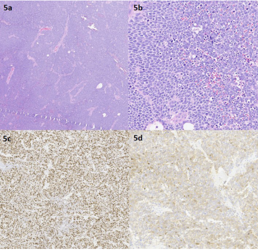 Estudio histol&oacute;gico A. Hematoxilina-eosina 2x. Se observa una proliferaci&oacute;n difusa que forma nidos, algunos delimitados por vasos. B. Hematoxilina-eosina 30x. A mayor aumento se identifica que la neoplasia est&aacute; formada por c&eacute;lulas de n&uacute;cleo en &ldquo;sal y pimienta&rdquo;, con figuras mit&oacute;ticas e infiltrado inflamatorio en peque&ntilde;os focos. C. Ki67, 10x. Intensa actividad proliferativa, como indica la expresi&oacute;n nuclear positiva y difusa en el &aacute;rea tumoral. D. CK20, 10x. Se observa una expresi&oacute;n citoplasm&aacute;tica difusa de la citoqueratina, que indica la estirpe del carcinoma de Merkel.