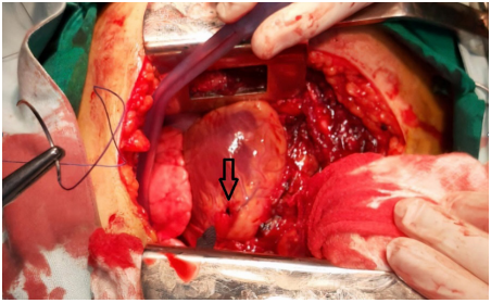 La flecha indica la lesi&oacute;n mioc&aacute;rdica localizada a la izquierda de la arteria descendente anterior, a nivel del ventr&iacute;culo izquierdo.