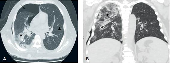Tomograf&iacute;a computarizada de t&oacute;rax (A: plano axial, B: plano coronal) que confirma la presencia de &aacute;reas de consolidaci&oacute;n en parches, mal definidas (estrella), multilobares derechas, con persistencia de neumot&oacute;rax (flecha) y tubo de drenaje. Campo pulmonar izquierdo sin alteraciones (tri&aacute;ngulo).