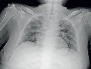 Radiograf&iacute;a de t&oacute;rax obtenida 6 d&iacute;as posterior a la imagen inicial, evidenciando resoluci&oacute;n completa de consolidaciones y neumot&oacute;rax derecho.