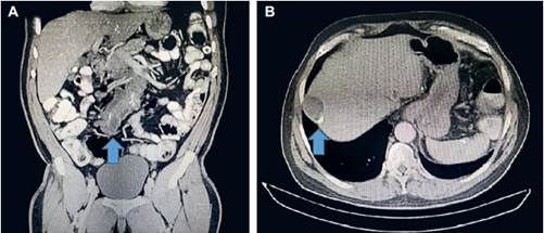 Tomograf&iacute;a computarizada de abdomen. A. Corte coronal en el que se observa la masa tumoral en la ra&iacute;z del mesenterio (flecha); B. Corte axial que confirma la presencia de un n&oacute;dulo qu&iacute;stico hipodenso en el segmento VIII del h&iacute;gado, que mide 43x30 mm y tiene pared calcificada (flecha).