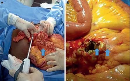 Hallazgos en la laparotom&iacute;a exploratoria. A. M&uacute;ltiples lesiones calcificadas en forma de panal o tub&eacute;rculo, de diferentes tama&ntilde;os, dependiente de mesenterio del intestino delgado; B. Contenido interno de tumoraci&oacute;n gelatinoso color pardo, asociado a quistes perlados (flecha).