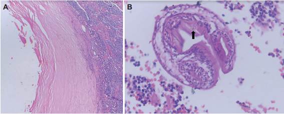Im&aacute;genes microsc&oacute;picas. Ampliaci&oacute;n 40x. A. Lesi&oacute;n pseudoqu&iacute;stica sin epitelio de recubrimiento, con fibrosis y &aacute;reas de calcificaci&oacute;n, asociado a ligero aflujo e infiltrado inflamatorio cr&oacute;nico linfoplasmocitario; B. Se reconoce focalmente forma parasitaria compatible con Echinococus granulosus y se aprecia su triple recubrimiento de membrana con material birrefringente en su interior (Flecha).