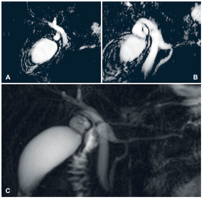 Colangioresonancia. A. Se observa la v&iacute;a biliar intra y extrahep&aacute;tica levemente dilatada. B-C. Lesi&oacute;n hipodensa en conducto c&iacute;stico sospechoso de c&aacute;lculo y dilataci&oacute;n del Santorini (Santorinocele?).