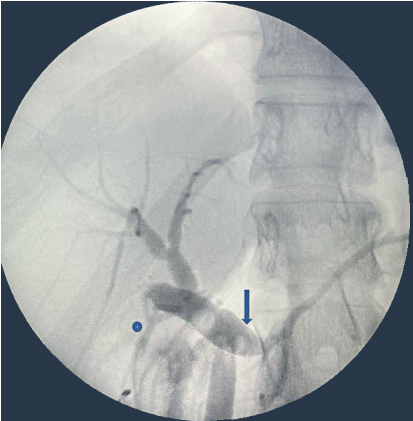 Colangiograf&iacute;a intraoperatoria donde se aprecia la v&iacute;a biliar extrahep&aacute;tica dilatada, con aparente conducto c&iacute;stico superpuesto (flecha), con terminaci&oacute;n en el conducto pancre&aacute;tico, conducto hep&aacute;tico derecho accesorio (c&iacute;rculo azul) que desemboca en el c&iacute;stico.
