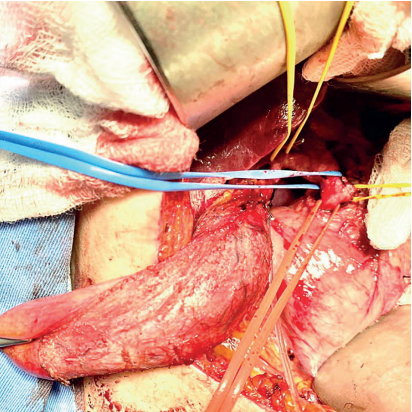 Imagen intraoperatoria que permite identificar el conducto accesorio derecho (Vessel loop&reg; amarillo superior), el conducto col&eacute;doco (Vessel loop&reg; azul) y la duplicaci&oacute;n de col&eacute;doco (Vessel loop&reg; rojo y amarillo inferior).