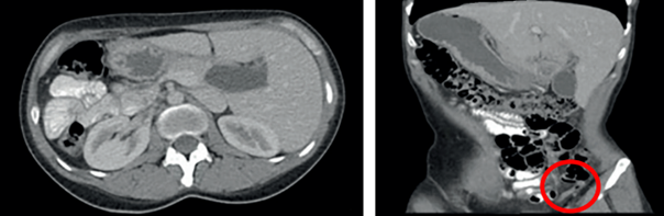 En la tomograf�a computarizada de abdomen se aprecia el situs inversus totalis con cambios inflamatorios en el ap�ndice cecal ubicado en el lado izquierdo.