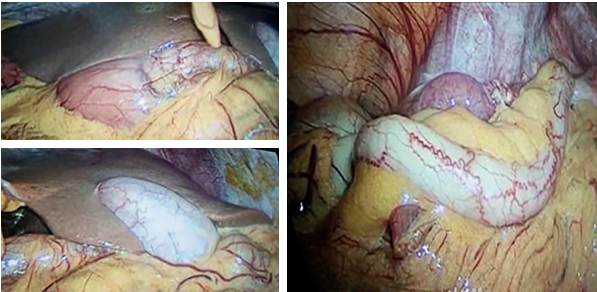 Visualizaci�n laparosc�pica de los �rganos intraabdominales en un paciente con situs inversus totalis. Fuente: Im�genes propias de los autores.
