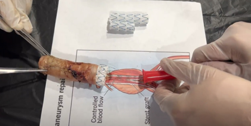 Colocaci�n del explantador de Cabrera.