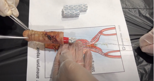 Activaci�n del explantador de Cabrera. Colapso de la endopr�tesis por el explantador de Cabrera y liberaci�n de la fijaci�n suprarrenal de la endopr�tesis por el explantador de Cabrera.