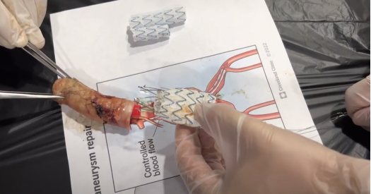 Explantaci�n final de la endopr�tesis por el explantador de Cabrera.