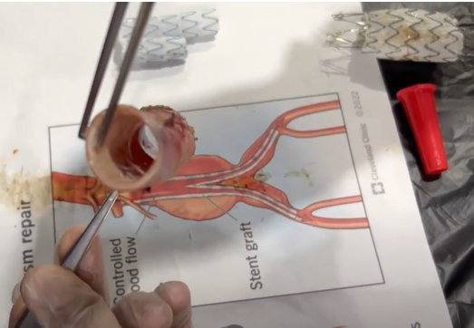Resultado de la pared a�rtica sin da�os al finalizar la explantaci�n de la endopr�tesis por el explantador de Cabrera.