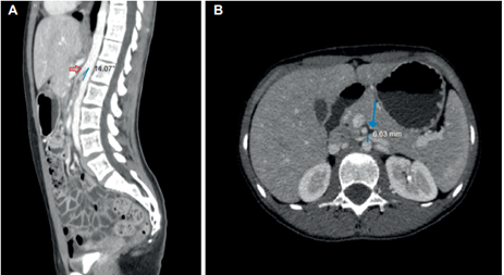 Tomograf�a computarizada de abdomen contrastada. A) Reconstrucci�n en plano sagital en el cual se aprecia una disminuci�n del �ngulo aortomesent�rico de 14,5�. B) Reconstrucci�n en plano axial donde se observa una reducci�n en la distancia aortomesent�rica de 6,8 mm.