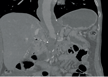 Tomograf�a de abdomen con angiograma donde se observa un aneurisma toracoabdominal y oclusi�n aorto-il�aca (flecha).