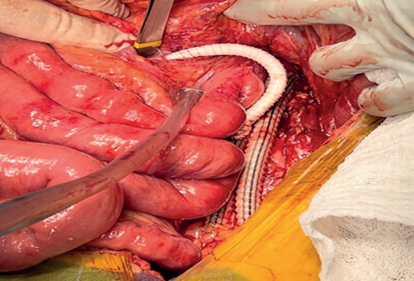 Baip�s retrogrado aorto-mesent�rico superior v�a transabdominal.