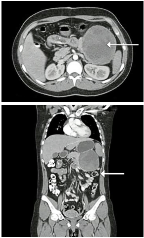 Tomograf�a computarizada de abdomen con medio de contraste, cortes axial y coronal, donde se observa la lesi�n en el hipocondrio izquierdo, en vecindad al bazo.