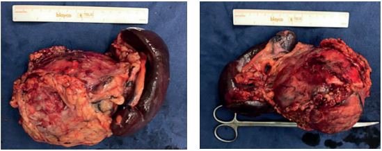 Pieza quir�rgica. Tumor de 14 x 13 cm dependiente del cuerpo del p�ncreas, en contacto con el meso del colon transverso, la fascia de Gerota, la gl�ndula suprarrenal e infiltraci�n del hilio espl�nico.