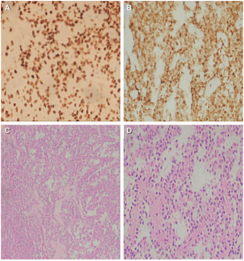 A: positividad de receptores de progesterona nuclear. B: betacatenina positividad nuclear. C y D: tinci�n de hematoxilina y eosina mostrando el patr�n pseudopapilar.