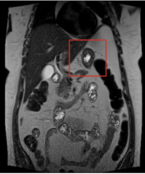 Resonancia nuclear magn�tica de abdomen, simple y con contraste, donde se observa lesi�n focal hipointensa en los pulsos T1, sutilmente hiperintensa en los pulsos T2 STIR e hipointensa en los pulsos T2 sin sustracci�n �sea, con paredes definidas lobuladas, signos de restricci�n en las secuencias de difusi�n y �vido refuerzo tras la administraci�n del contraste endovenoso en la fase arterial, con posterior lavado y homogenizaci�n de la lesi�n, que mide aproximadamente 49 x 34 mm en el plano axial.