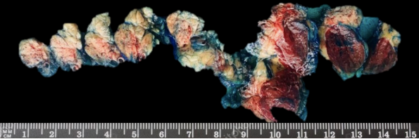 El examen macrosc�pico muestra una lesi�n bien delimitada, redondeada y rojiza, de 6 cm de di�metro, en medio de par�nquima pancre�tico normal.
