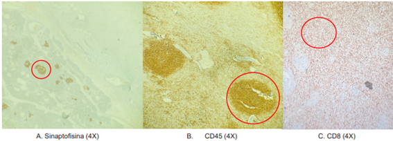 Inmunohistoqu�mica. A, muestra islotes de Langerhans positivos para Sinaptofisina. B, muestra positividad de CD45 en la pulpa blanca del tejido espl�nico. C, muestra positividad de CD8 en los sinusoides de la pulpa roja.
