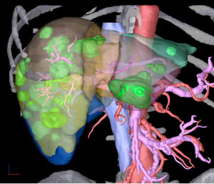 Uso de planificaci�n con inteligencia artificial para cirug�as complejas.