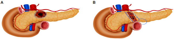 T�cnica de sutura continua cruzada. A. Sutura continua cruzada en corona en heridas por proyectil de arma de fuego. B. Sutura continua cruzada en transecci�n completa de p�ncreas en trauma cerrado.
