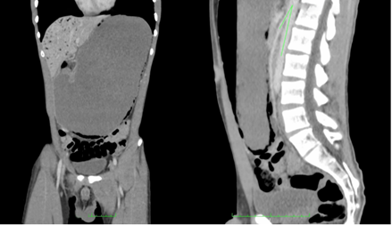 Tomograf�a computarizada de abdomen inicial, antes del tratamiento con soporte nutricional, que muestra el est�mago muy dilatado, aire en la vena porta y un �ngulo aorto-mesent�rico de 16 grados.