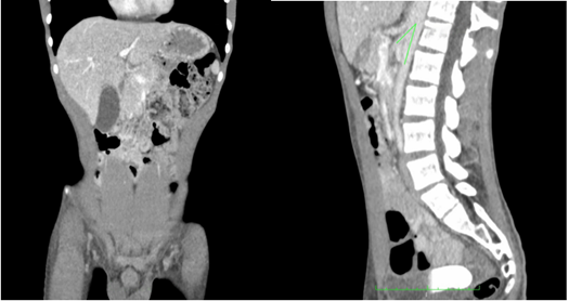Tomograf�a computarizada de abdomen despu�s de un mes de tratamiento con soporte nutricional, en la que se observa que el est�mago ha retornado a su tama�o usual, no hay aire en la vena porta y el �ngulo aorto-mesent�rico mide 28,9 grados.