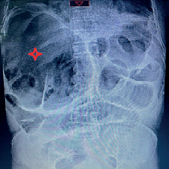 Radiograf�a simple de abdomen donde se observa la distensi�n de asas intestinales delgadas proyectadas sobre el mesogastrio de hasta 6 cm; con un patr�n en pila de moneda y ausencia de gas distal, adem�s de sobredistensi�n de un asa de presunci�n de intestino grueso sobre el �ngulo hep�tico, con signo sugestivo del grano de caf� (estrella roja).