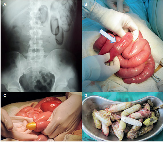 A. Radiograf�a diagn�stica; B. Orde�o de las capsulas; C. Enterotom�a y extracci�n de c�psulas; D. C�psulas recuperadas.