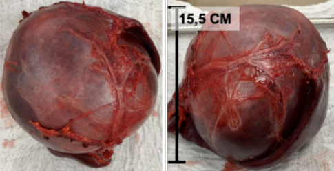 Im�genes intraoperatorias de la lesi�n qu�stica que ocupa la mayor parte del tejido espl�nico. Peso: 531 gramos. Dimensiones 15,5 x 12,4 x 9,5 cm. Superficie externa lisa e irregular, color caf� y viol�ceo.