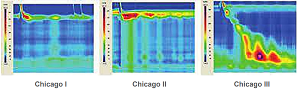 Manometric achalasia types. Type 1 is characterized by absence of esophageal pressurization with swallows; Type II has panesophageal pressurization in 20% or more swallows; and Type III is characterized by spasm (20% or more swallows with premature contraction).