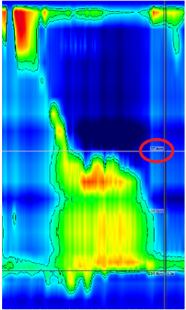 Manometric extension of the spastic segment in type III achalasia. This extension (circle) may be used to tailor myotomy length.