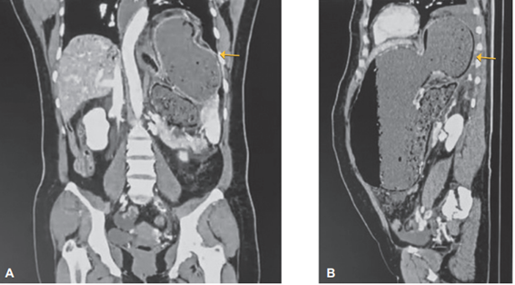 Tomograf�a computarizada abdominop�lvica con reconstrucci�n en plano coronal (A) y sagital (B). Se aprecia una hernia hiatal con protrusi�n del est�mago hacia la cavidad tor�cica.