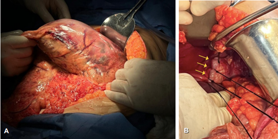 A. V�lvulo g�strico agudo �rganoaxial con isquemia y necrosis; B. Cierre del defecto hiatal con puntos separados de seda (flechas amarillas).