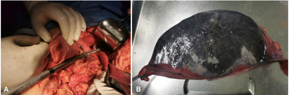 A. Confecci�n de la gastrectom�a; B. Pieza quir�rgica extra�da posterior a gastrectom�a vertical en manga como resultado de la necrosis presente en la curvatura mayor de est�mago.