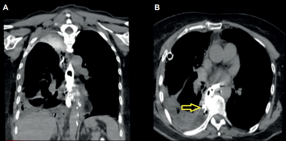 Esofagograf�a por tomograf�a con contraste oral. A. Corte coronal. B. Corte Axial. Flecha amarilla se�ala la extravasaci�n por disrupci�n en topograf�a infracarinal hacia el espacio pleural derecho.