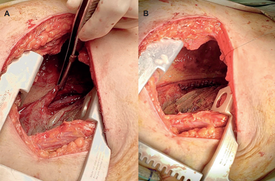 A. Perforaci�n esof�gica del tercio medio, con una longitud de 5 cm. B. Esofagorrafia.