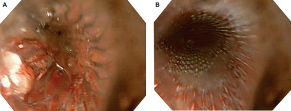 Inserci�n de stent cubierto v�a endosc�pica, posicionado en es�fago medio.