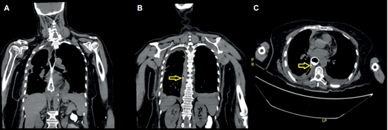Esofagograf�a por tomograf�a con contraste oral: extravasaci�n del medio de contraste oral en cara posterolateral derecha del stent y derrame pleural derecho. A: Corte coronal a nivel mediastinal, B: Corte coronal en el receso costofr�nico bilateral, flecha amarilla se�ala extravasaci�n, C: Corte axial. La flecha amarilla se�ala la extravasaci�n.