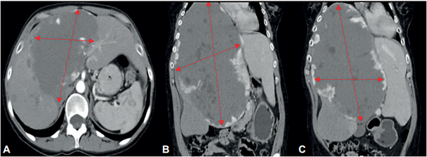 Tomograf�a de abdomen contrastada en pacientes con hemangioma extremadamente gigante. A. Corte transversal de hemangioma gigante comprometiendo segmentos hep�ticos centrales. B. y C. Corte coronal de paciente con hemangioma extremadamente gigante.
